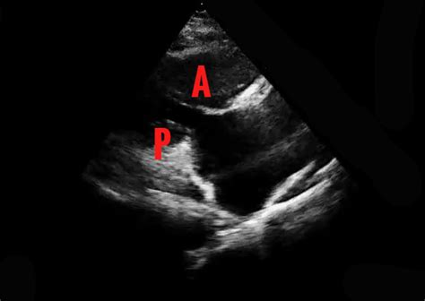 Echocardia Atlas