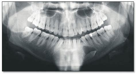 Impacted Mandibular Left Canine Associated With A Dentigerous Cyst