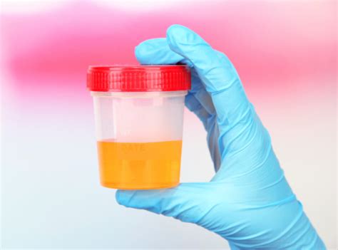 Nephrotic syndrome, a kidney disease, and the risk of protein in urine
