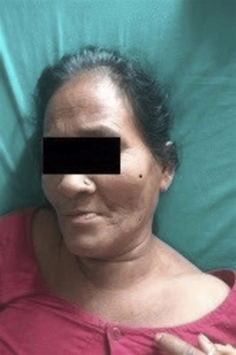 Lemierre Syndrome Patient With Neck Stiffness Cervical Lymphadenopathy