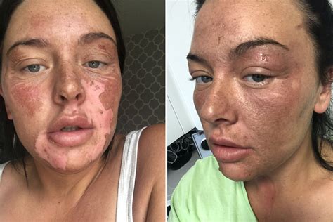 Mum Suffers Horrific Facial Burns After Microwave Egg Poaching Hack Goes Wrong And Boiling Water