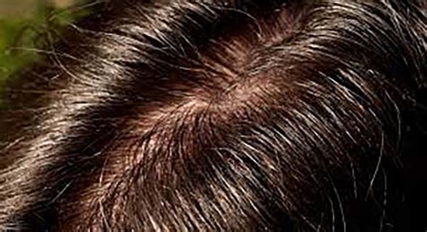 Oily Scalp Causes And Solutions Paragon Traders