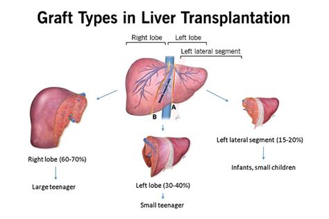 Join us for the best in liver transplant education and networking. Pediatric Liver Transplant Program | Liver Transplant ...
