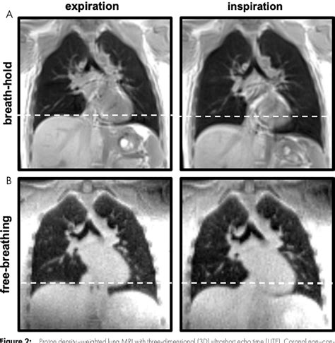 Figure 2 From Functional Mri Of The Lungs Using Single Breath Hold And