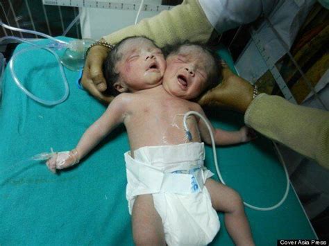 Very Very Rare Conjoined Twins Born In India Pictures Huffpost