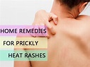 Home Remedies For Prickly Heat Rashes - Boldsky.com