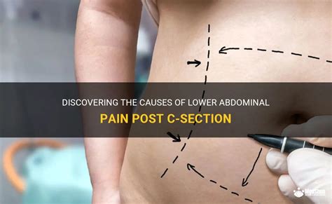 Discovering The Causes Of Lower Abdominal Pain Post C Section MedShun