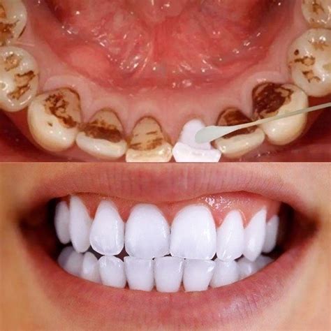 It is very important to get rid of plaque and tartar before they can cause any more oral diseases. How To Get Rid Of Tartar In Teeth Naturally | 7 Home Remedies