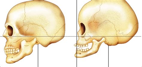 Morphometrical Characteristics Of Down Syndrome Ds Skull And Brain