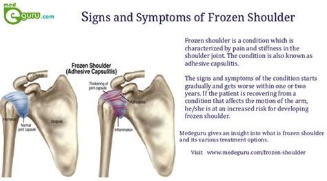 Frozen Shoulder Exercises Adhesive Capsulitis Treatmentmed E Guru