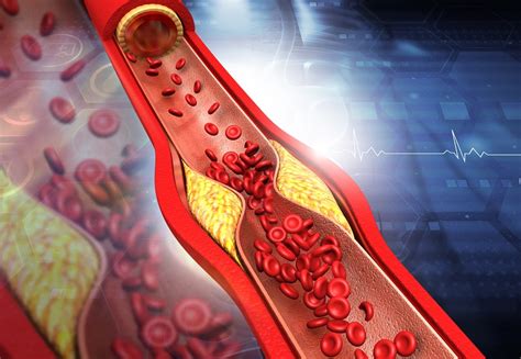 How Doctors Treat Clogged Arteries Without Surgery