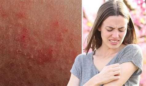 The ‘little Known Itchy Rash Caused By Sunlight That Affects One In