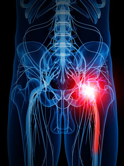 Sciatica is a common form of radicular pain. Optimal Pain Management After Total Knee Arthroplasty ...