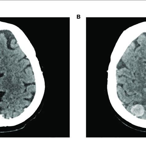 Development Of An Asymptomatic Brain Metastasis In Patient Case 1