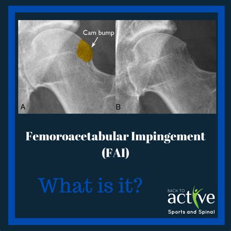 Fai Femoroacetabular Impingement