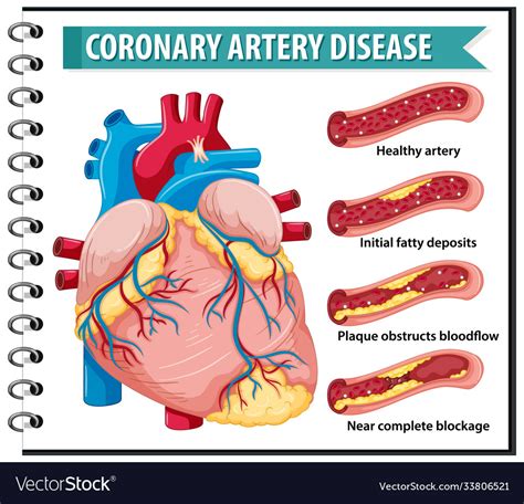 Coronary Artery Disease For Health Education Vector Image