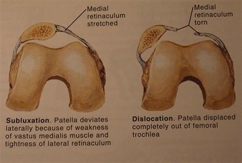 Patellar Tracking Disorder 👨‍⚕️singapore Orthopaedic And Neurosurgery