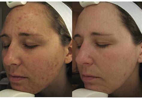 Smoothbeam Laser Treatment For Sebaceous Hyperplasia The Best Picture