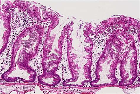 Figure 2 From Endoscopic Diagnosis Of Sessile Serrated Adenoma Polyp