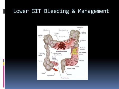 Lower Gastrointestinal Bleeding