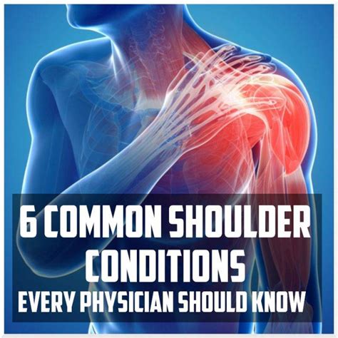 6 Common Shoulder Conditions Every Physician Should Know Sports