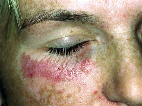 Acute Chemical Burn With Sharply Demarcated Erythema And Superficial