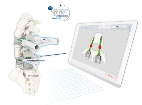 3d Printed Implants The Future Of Spine Cm Medical