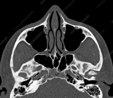 Anatomy next provides anatomy learning tools for students and teachers. Normal sinuses, CT scan - Stock Image C029/4630 - Science ...