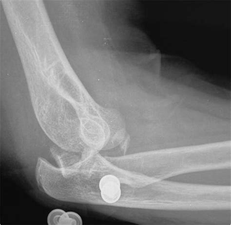 Fratture lussazioni di gomito - Il Gomito