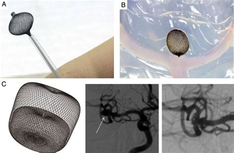 Technology Developments In Endovascular Treatment Of Intracranial