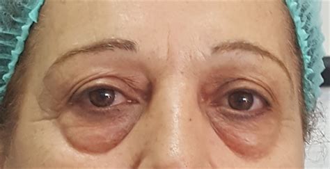 Recurrence Of Lower Eyelid Fat Pads Herniated Fat After