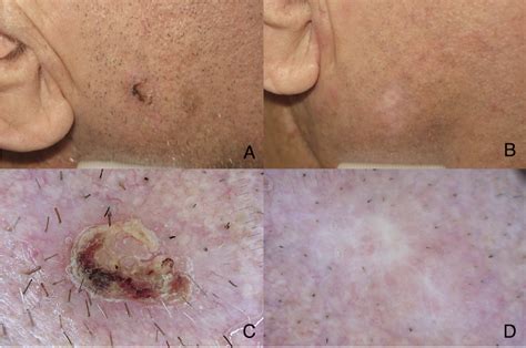 Clinical Image Of Basal Cell Carcinoma A Before And B Two Months