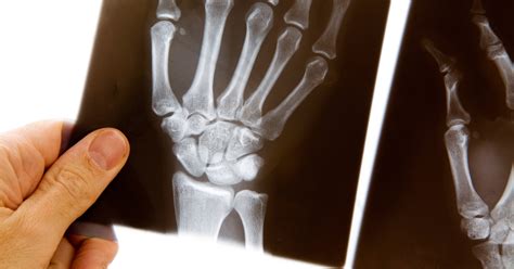 Diagnosing and Treating Scaphoid Fractures of the Wrist