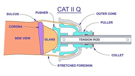 types of circumcision explained ureadthis