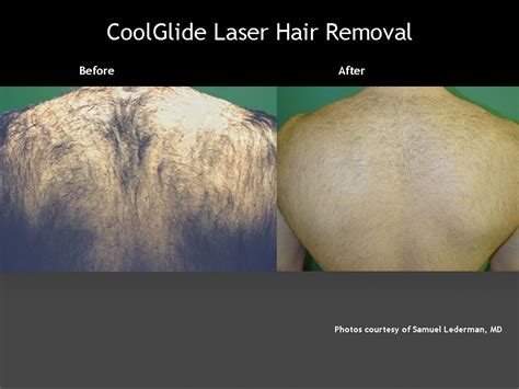 Laser Back Hair Removal Cutera The Dermatology Clinic