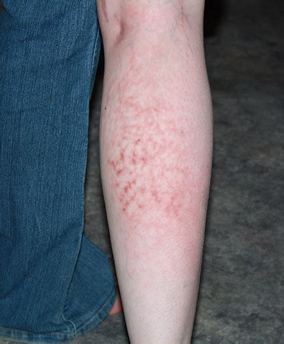 Dermatitis Herpetiformis I Was Originally Told This Was Li Flickr