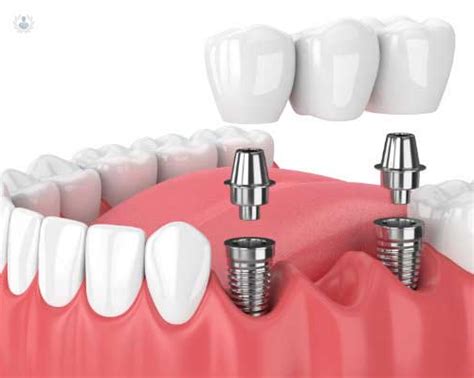 Implantes Dentales De Carga Inmediata Cuáles Son Sus Beneficios Top