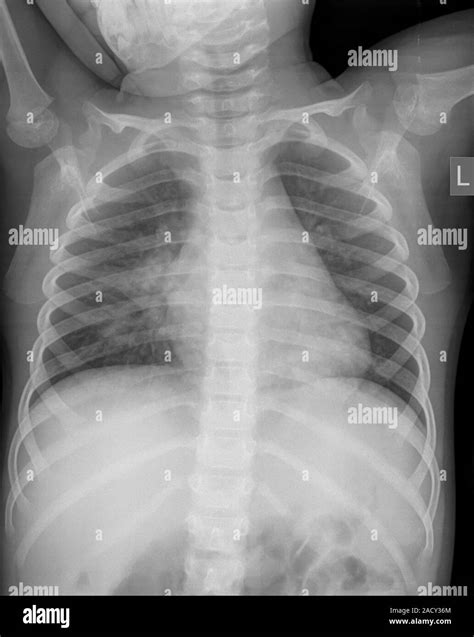 Chest X Ray Of A 3 Year Old Female Patient With Signs Of Pneumonia In
