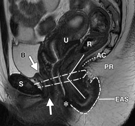 Pelvic Floor Failure Mr Imaging Evaluation Of Anatomic And Functional