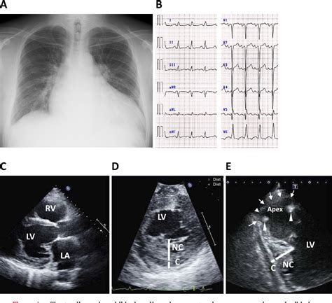 Figure 1 From Left Ventricular Noncompaction With Multiple Thrombi In