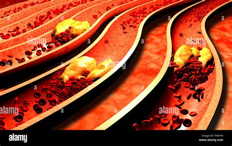 clogged artery with platelets and cholesterol plaque atherosclerosis fibrous plaque formation