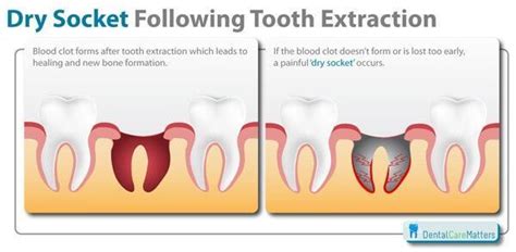 Infection One Month After Wisdom Tooth Extraction Healthlines