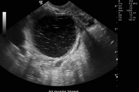 Hemorrhagic Ovarian Cyst Ultrasound Hot Sex Picture