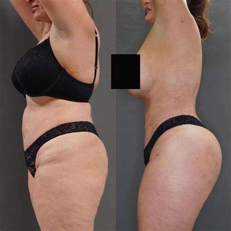 MAFS Sarah Roza Reveals Brazilian Butt Lift Results Photo The Advertiser