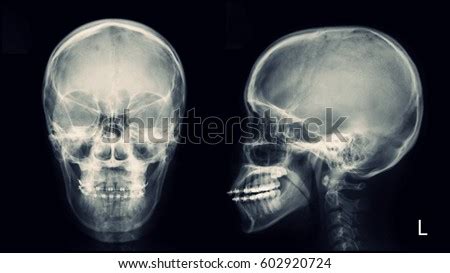 I'm not sure just what that 6.5 mm fragment is, reported sturdivan. Skull Ap Xray Stock Photo 680406622 - Shutterstock
