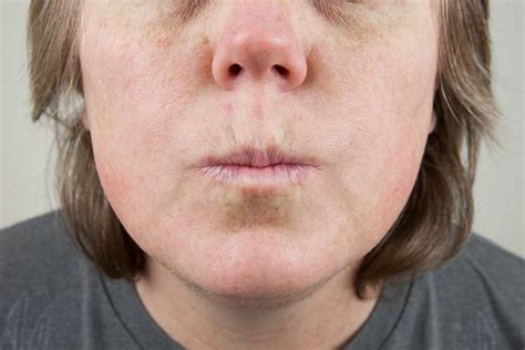 Home Remedy For Upper Lip Lines Just Good Stuff In 2019 How To Line