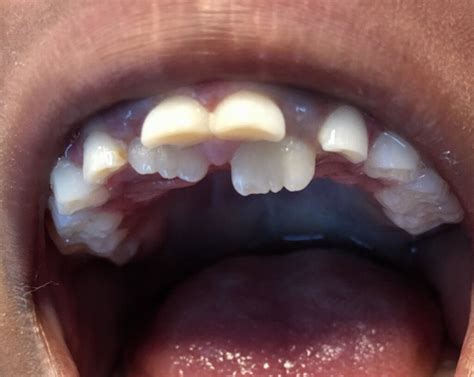 For You What Happens If A Permanent Tooth Falls Out Tooth Bantuanbpjs