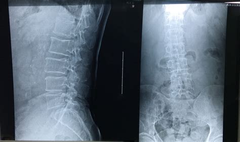 The central ray is perpendicular to the image. Plain X-ray films of the lumbar spine showing no obvious ...