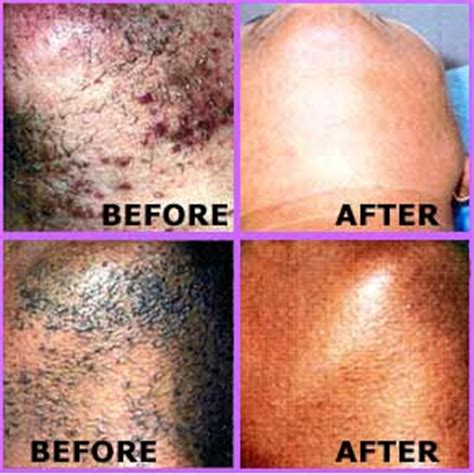 The most common is typically referred to as razor bumps. Ingrown Hairs Affecting African-Americans
