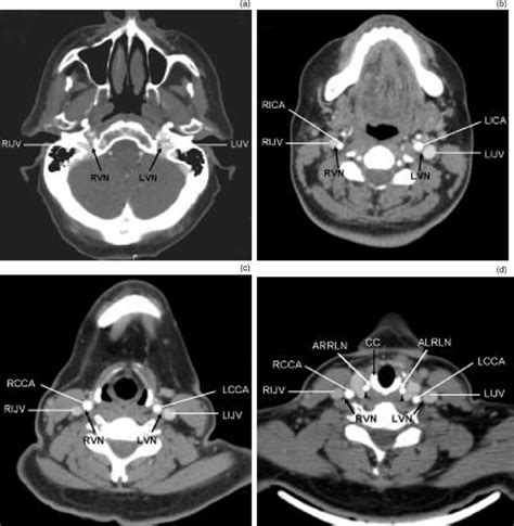 Axial Contrast Enhanced Computed Tomography Images Showing Normal